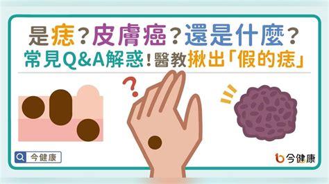 紅色的痣代表什麼|是痣？還是皮膚癌？皮膚科醫師教你揪出「假的痣」，。